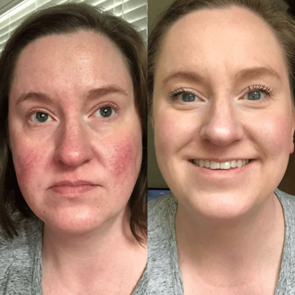 Rosalique 3 in 1 Anti-Redness Miracle Formula SPF50